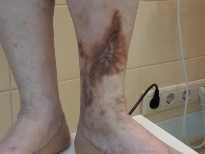 Лечение трофических язв на ногах